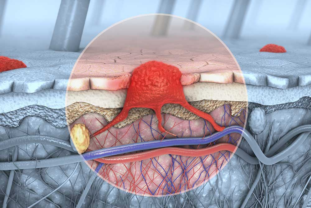 A graphic depiction of a melanoma cancer cell.